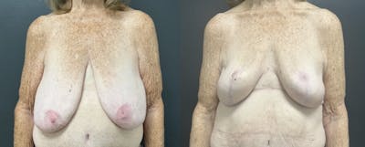 Mastopexy (Breast Lift) Before & After Gallery - Patient 193957 - Image 1