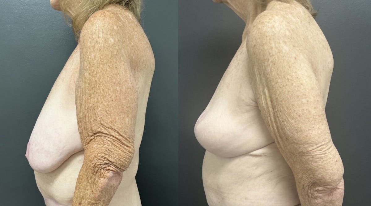 Mastopexy (Breast Lift) Before & After Gallery - Patient 193957 - Image 3