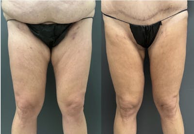 Thighplasty (Thigh Lift) Before & After Gallery - Patient 169509 - Image 1