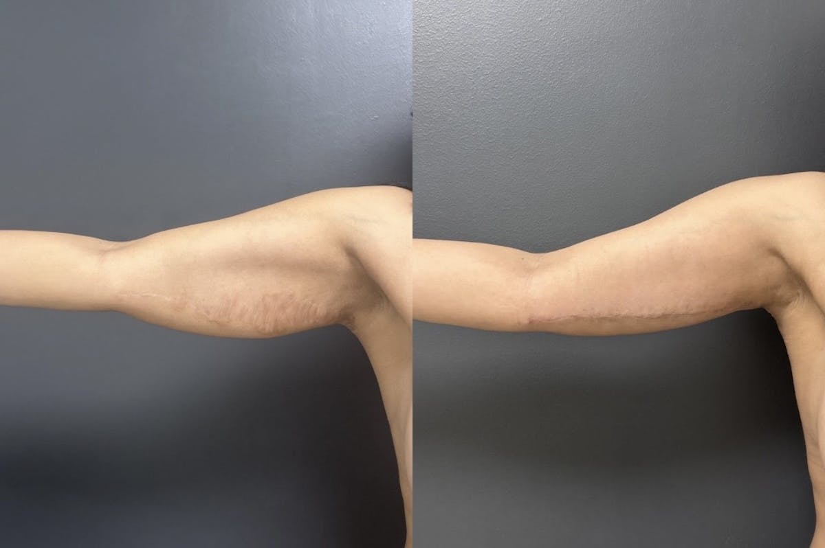 Scar Revision Before & After Gallery - Patient 244718 - Image 1