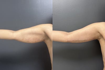 Scar Revision Before & After Gallery - Patient 244718 - Image 1