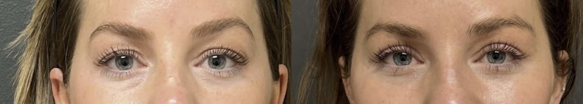Blepharoplasty Before & After Gallery - Patient 257182 - Image 1