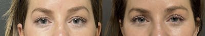 Blepharoplasty Before & After Gallery - Patient 257182 - Image 1