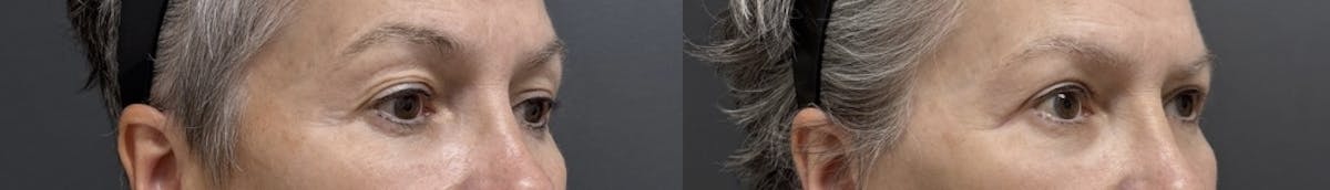 Blepharoplasty Before & After Gallery - Patient 383217 - Image 2