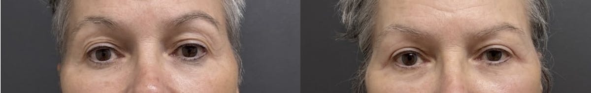 Blepharoplasty Before & After Gallery - Patient 383217 - Image 1