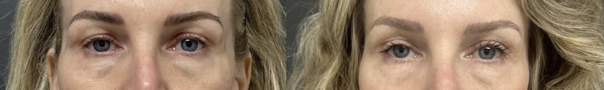 Blepharoplasty Before & After Gallery - Patient 752260 - Image 1
