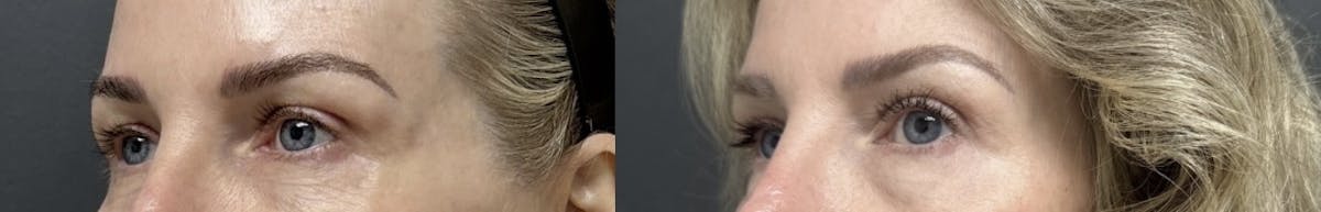 Blepharoplasty Before & After Gallery - Patient 752260 - Image 2