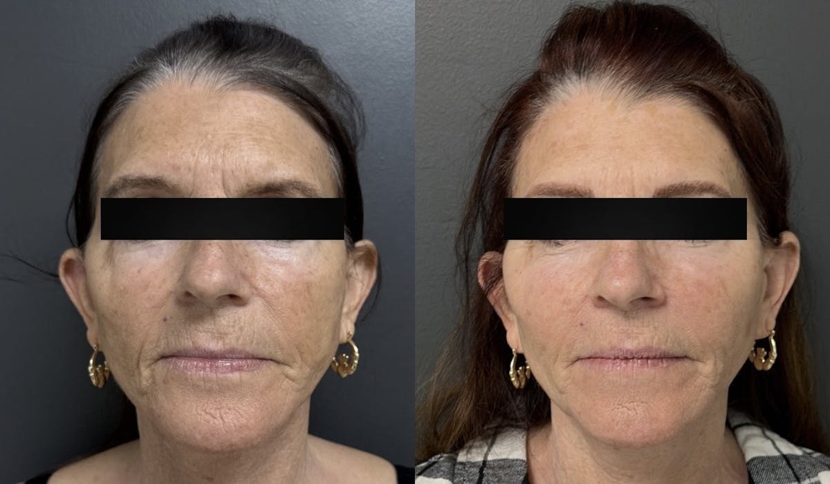 Facial Fat Grafting Before & After Gallery - Patient 269053 - Image 1