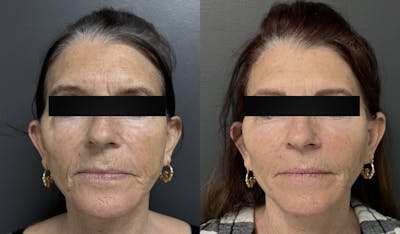Facial Fat Grafting Before & After Gallery - Patient 269053 - Image 1