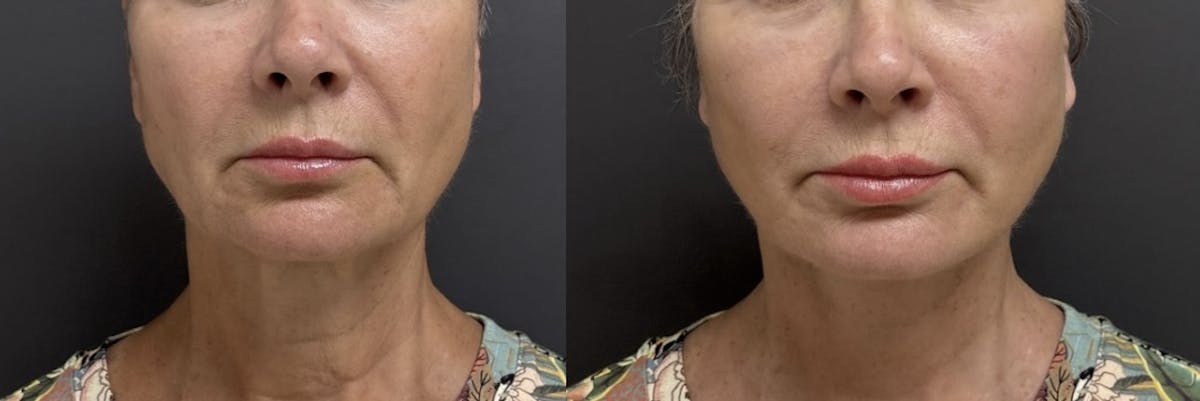 Facial Fat Grafting Before & After Gallery - Patient 182883 - Image 1