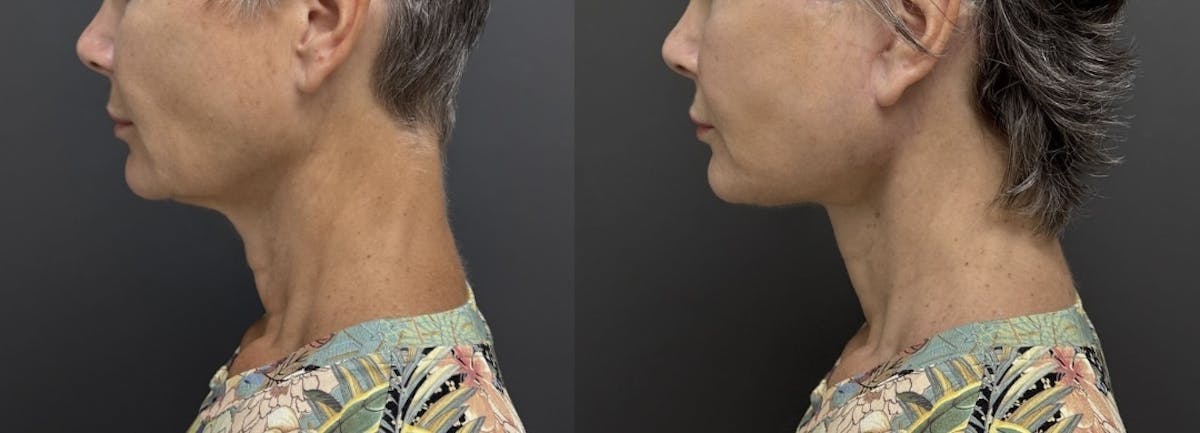 Facial Fat Grafting Before & After Gallery - Patient 182883 - Image 3