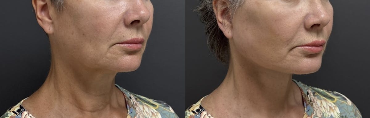Facial Fat Grafting Before & After Gallery - Patient 182883 - Image 2