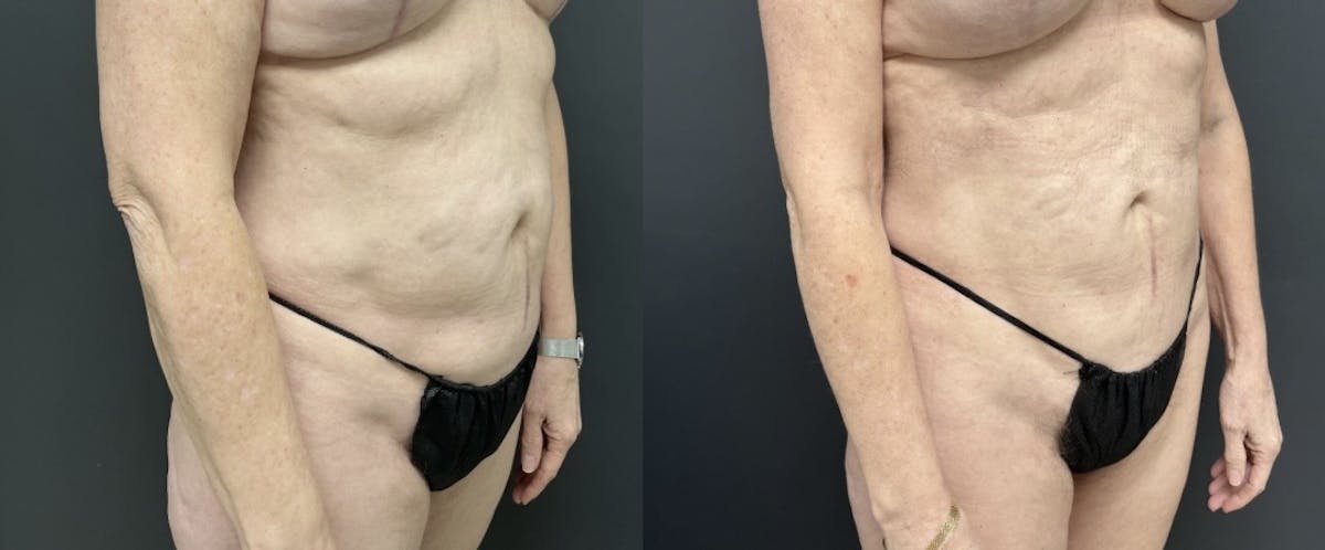 Liposuction Before & After Gallery - Patient 254354 - Image 2