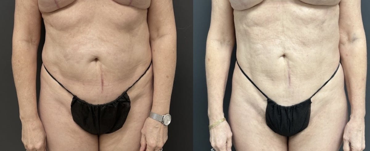 Liposuction Before & After Gallery - Patient 254354 - Image 1
