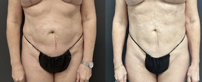Liposuction Before & After Gallery - Patient 254354 - Image 1