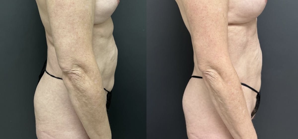 Liposuction Before & After Gallery - Patient 254354 - Image 3