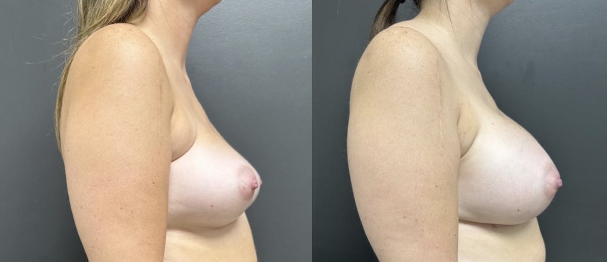 Breast Augmentation Before & After Gallery - Patient 277597 - Image 2