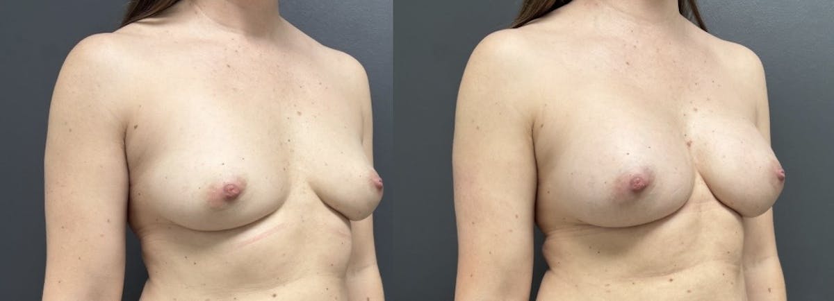 Breast Augmentation Before & After Gallery - Patient 397480 - Image 2