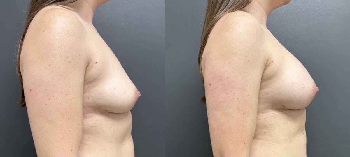 Breast Augmentation Before & After Gallery - Patient 397480 - Image 3