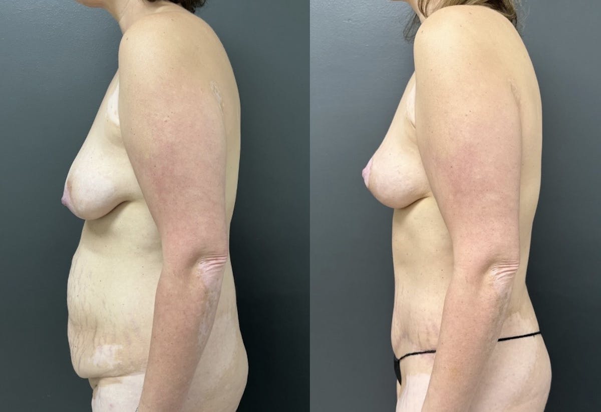 Abdominoplasty (Tummy Tuck) Before & After Gallery - Patient 799360 - Image 3