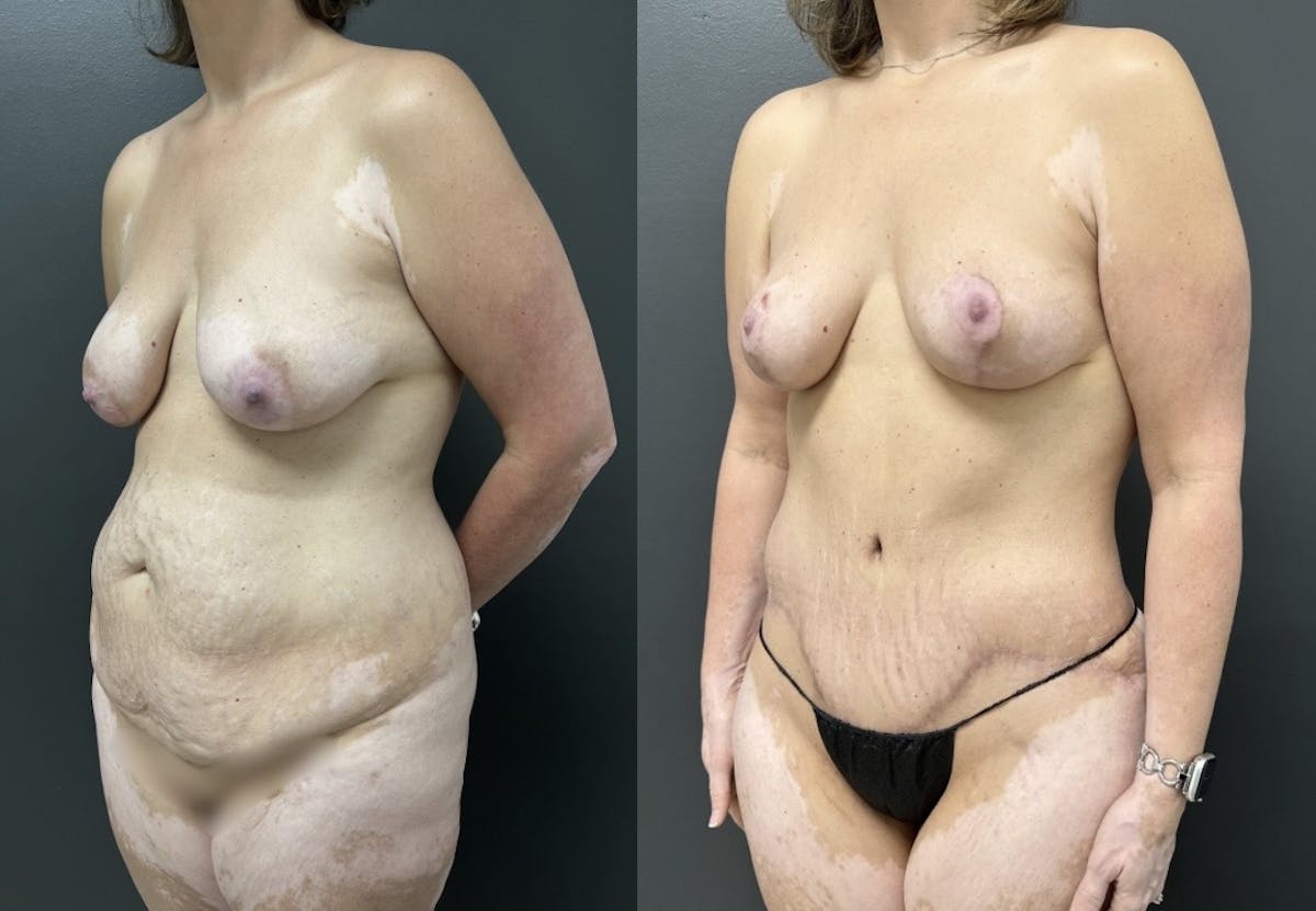 Abdominoplasty (Tummy Tuck) Before & After Gallery - Patient 799360 - Image 2