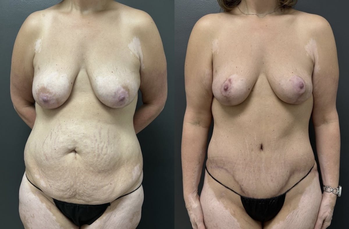 Abdominoplasty (Tummy Tuck) Before & After Gallery - Patient 799360 - Image 1