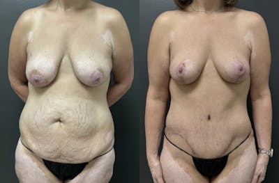 Abdominoplasty (Tummy Tuck) Before & After Gallery - Patient 799360 - Image 1