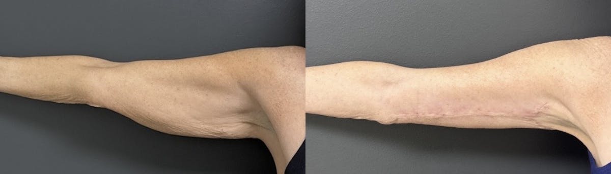 Brachioplasty (Arm Lift) Before & After Gallery - Patient 316228 - Image 2