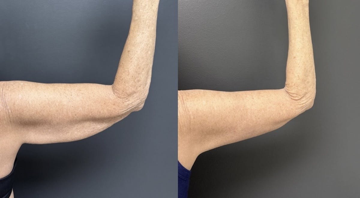 Brachioplasty (Arm Lift) Before & After Gallery - Patient 316228 - Image 1