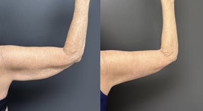 Brachioplasty (Arm Lift) Before & After Gallery - Patient 316228 - Image 1