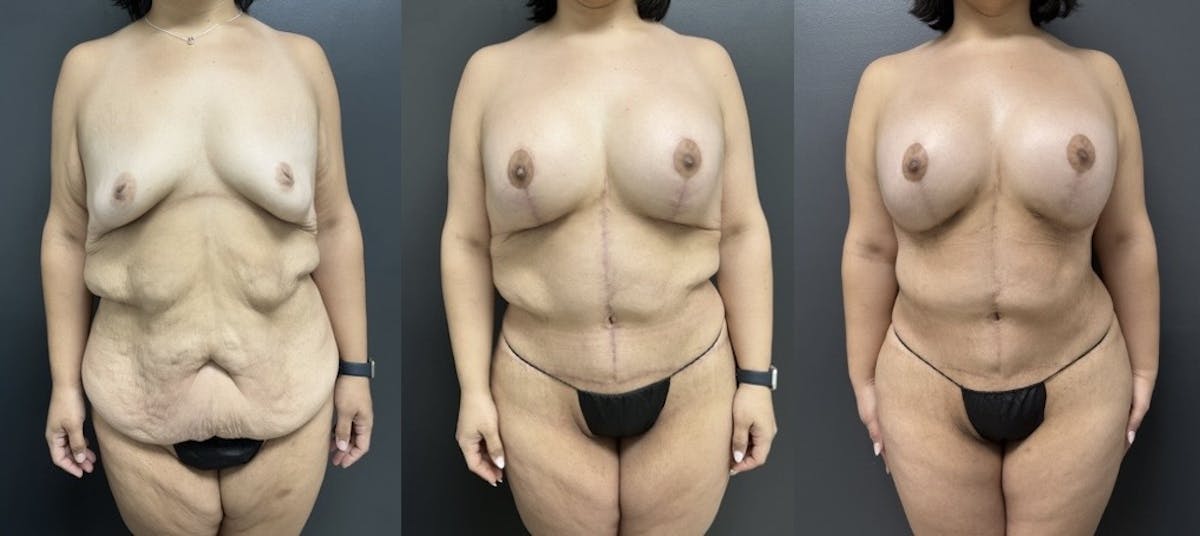 Abdominoplasty (Tummy Tuck) Before & After Gallery - Patient 108036 - Image 1