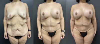 Abdominoplasty (Tummy Tuck) Before & After Gallery - Patient 108036 - Image 1