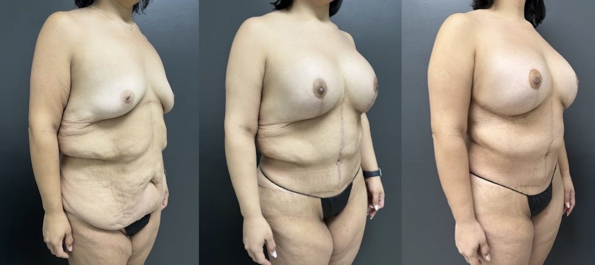 Abdominoplasty (Tummy Tuck) Before & After Gallery - Patient 108036 - Image 2