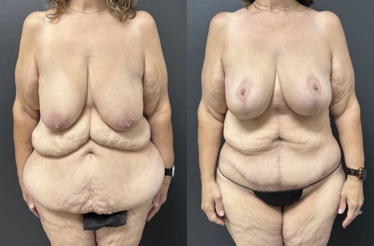 Fleur De Lis Abdominoplasty Before & After Gallery - Patient 400182 - Image 1