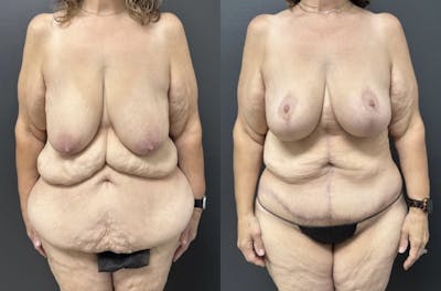 Fleur De Lis Abdominoplasty Before & After Gallery - Patient 400182 - Image 1