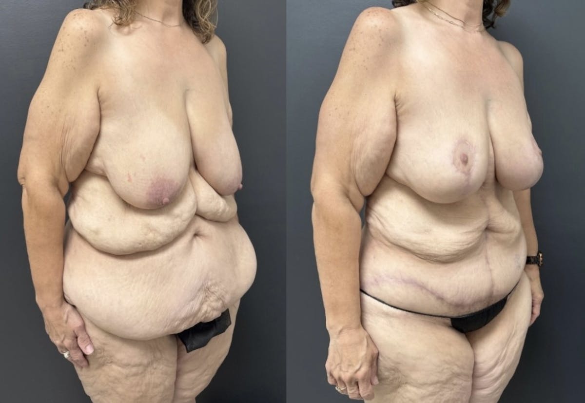 Fleur De Lis Abdominoplasty Before & After Gallery - Patient 400182 - Image 2