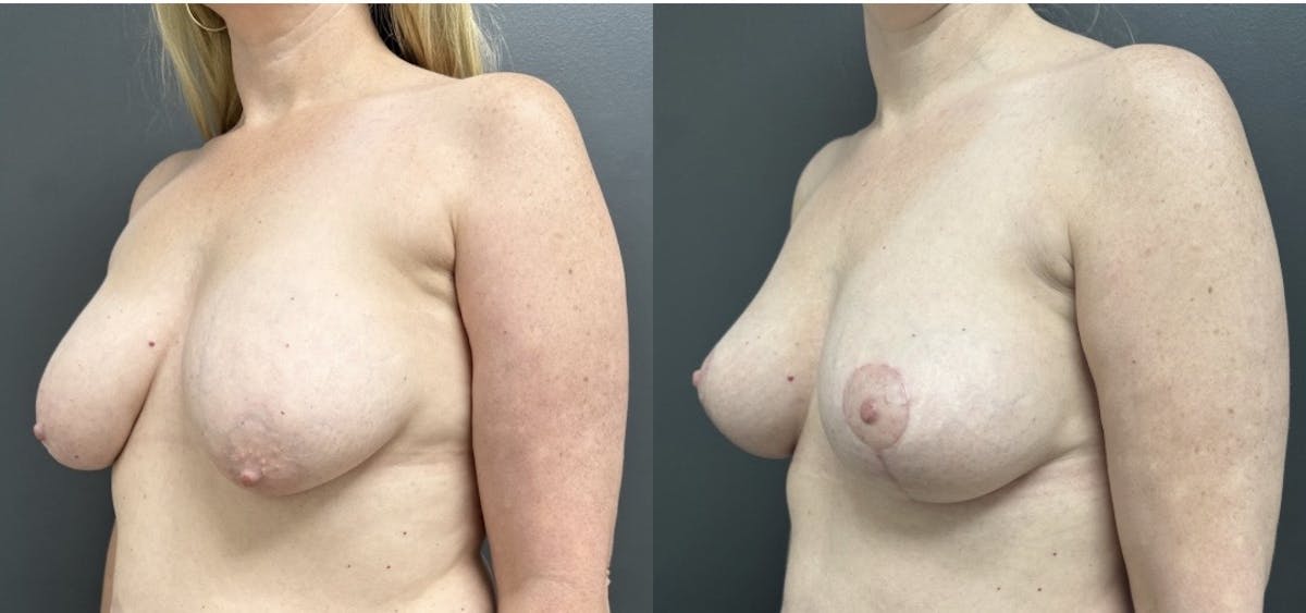 Breast Fat Grafting Before & After Gallery - Patient 407462 - Image 2