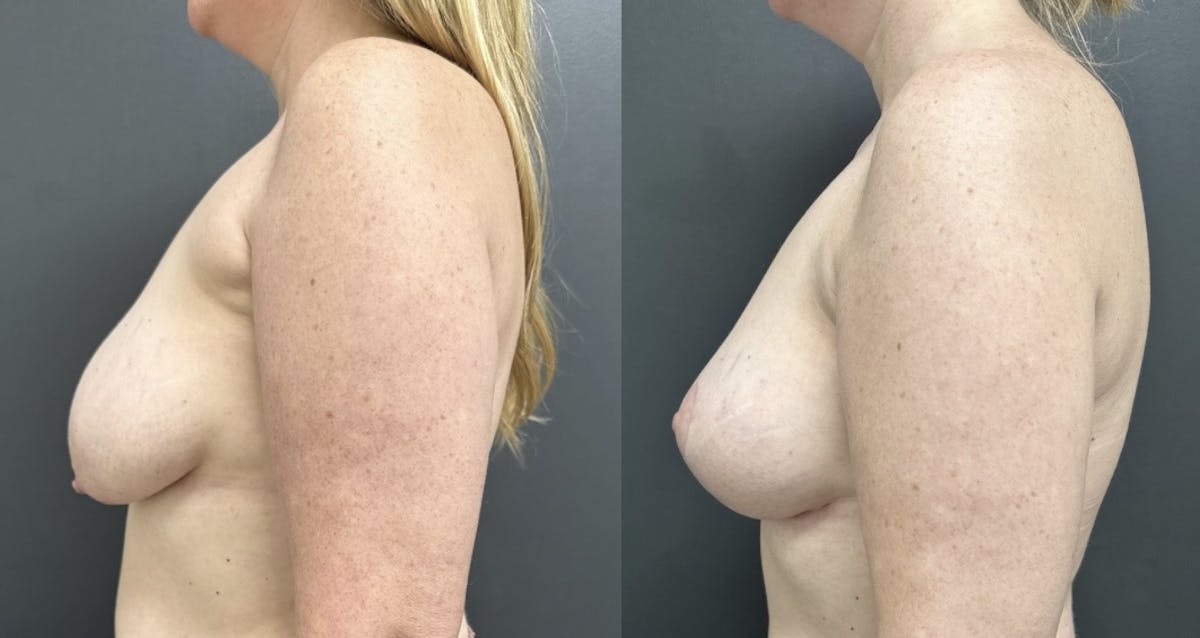 Breast Fat Grafting Before & After Gallery - Patient 407462 - Image 3