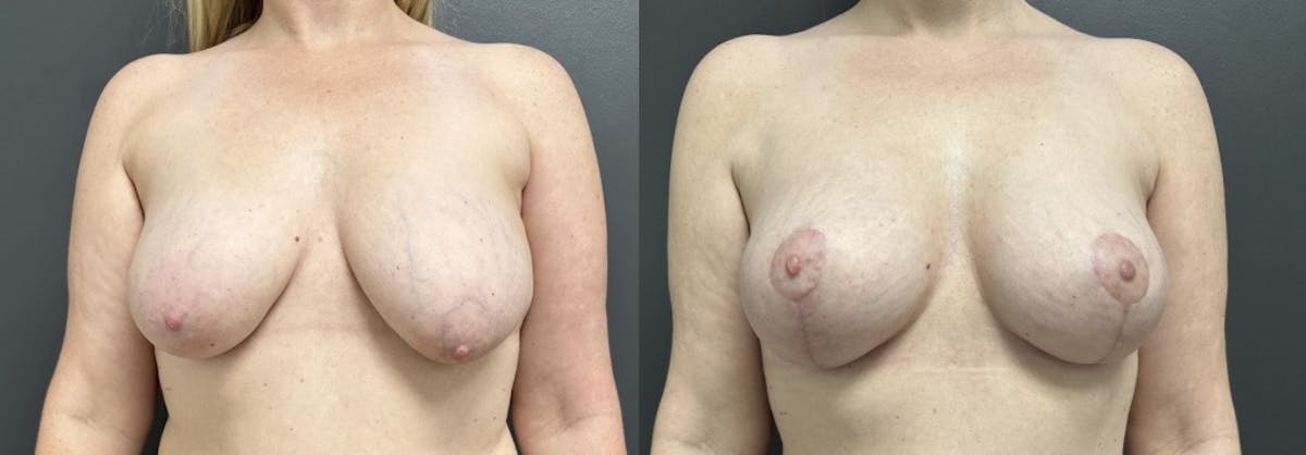 Breast Fat Grafting Before & After Gallery - Patient 407462 - Image 1