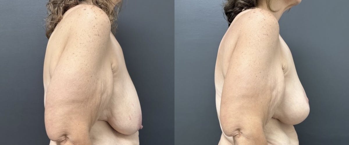 Mastopexy (Breast Lift) Before & After Gallery - Patient 393438 - Image 3