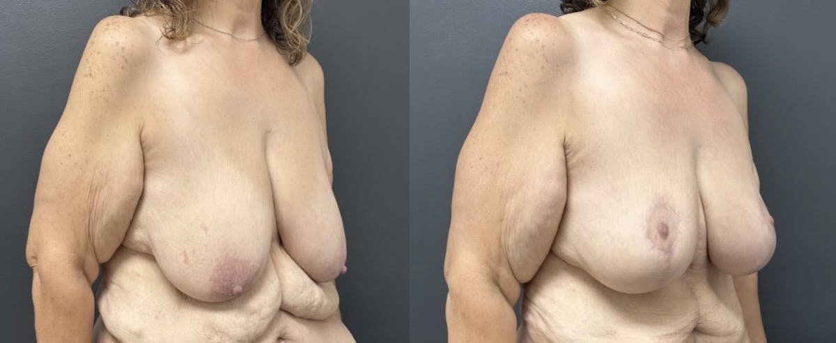 Mastopexy (Breast Lift) Before & After Gallery - Patient 393438 - Image 2