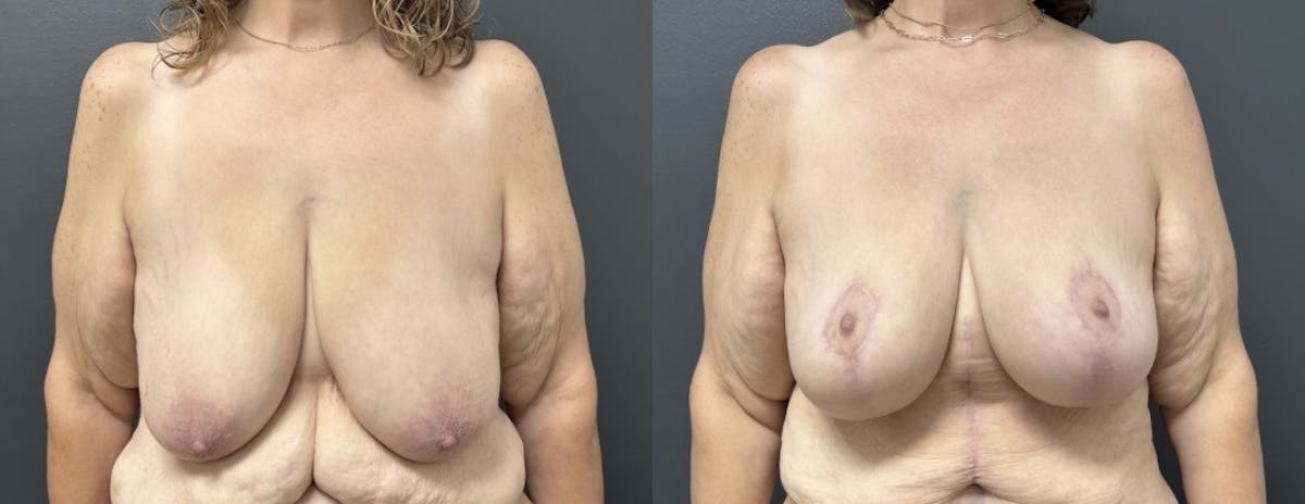 Mastopexy (Breast Lift) Before & After Gallery - Patient 393438 - Image 1