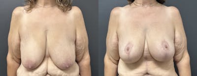 Mastopexy (Breast Lift) Before & After Gallery - Patient 393438 - Image 1