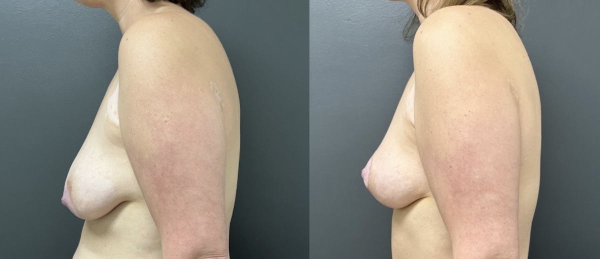 Mastopexy (Breast Lift) Before & After Gallery - Patient 224457 - Image 3
