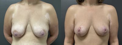 Mastopexy (Breast Lift) Before & After Gallery - Patient 224457 - Image 1
