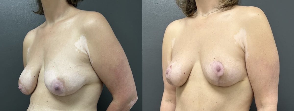 Mastopexy (Breast Lift) Before & After Gallery - Patient 224457 - Image 2