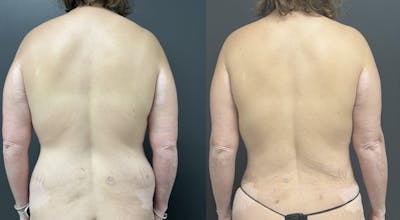 Liposuction Before & After Gallery - Patient 245336 - Image 1
