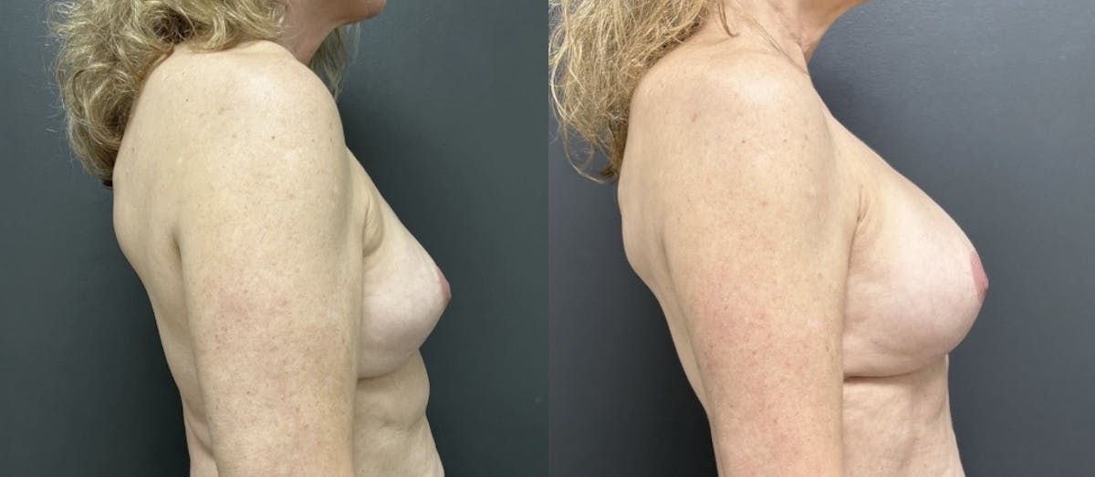 Breast Fat Grafting Before & After Gallery - Patient 293678 - Image 3
