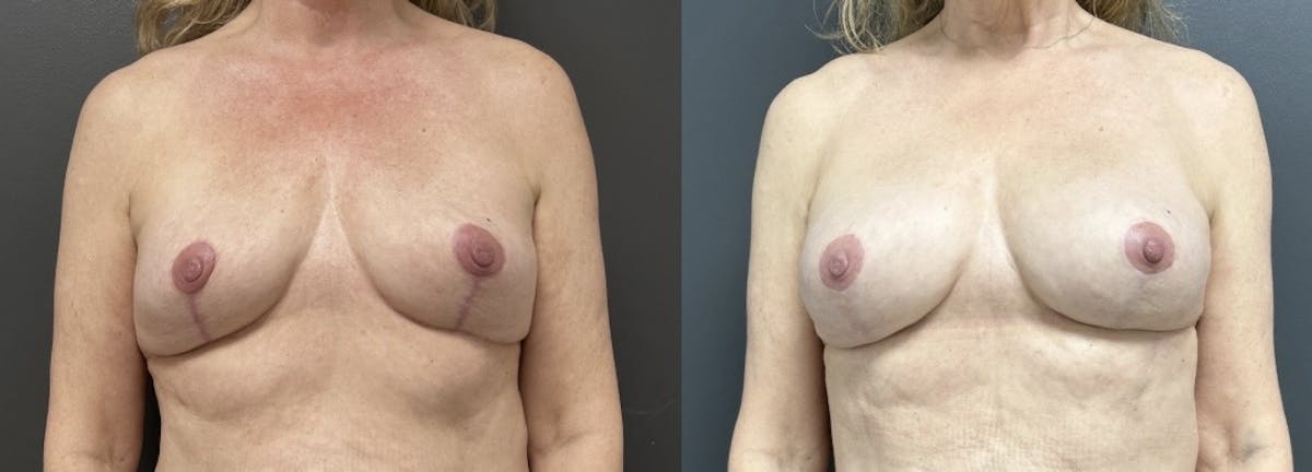 Breast Fat Grafting Before & After Gallery - Patient 293678 - Image 1