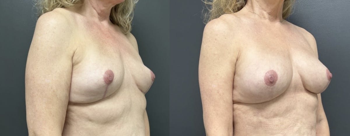 Breast Fat Grafting Before & After Gallery - Patient 293678 - Image 2